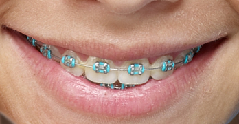 Resultado de imagen de ortodoncia en niños