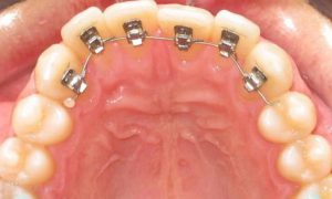 Ortodoncia Reducida