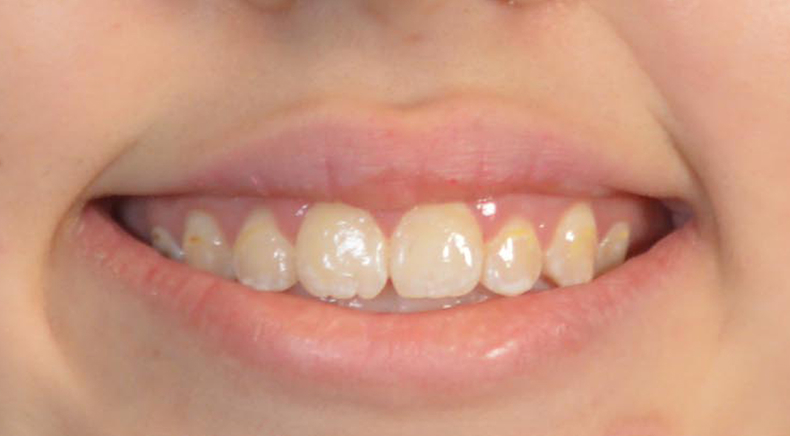 Foto antes