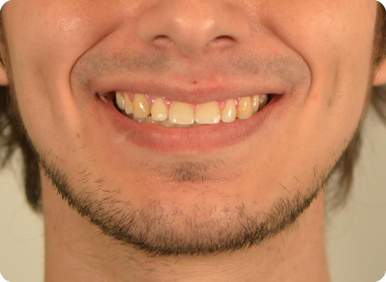 Foto antes